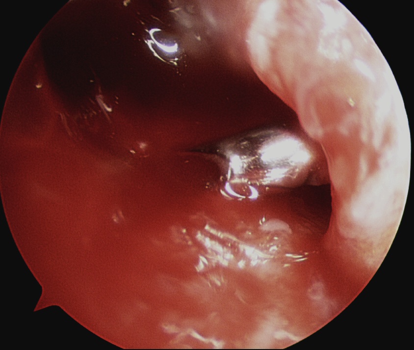 Rotator Cuff Repair PRP 2